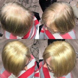 Hair Replacement Solution 1